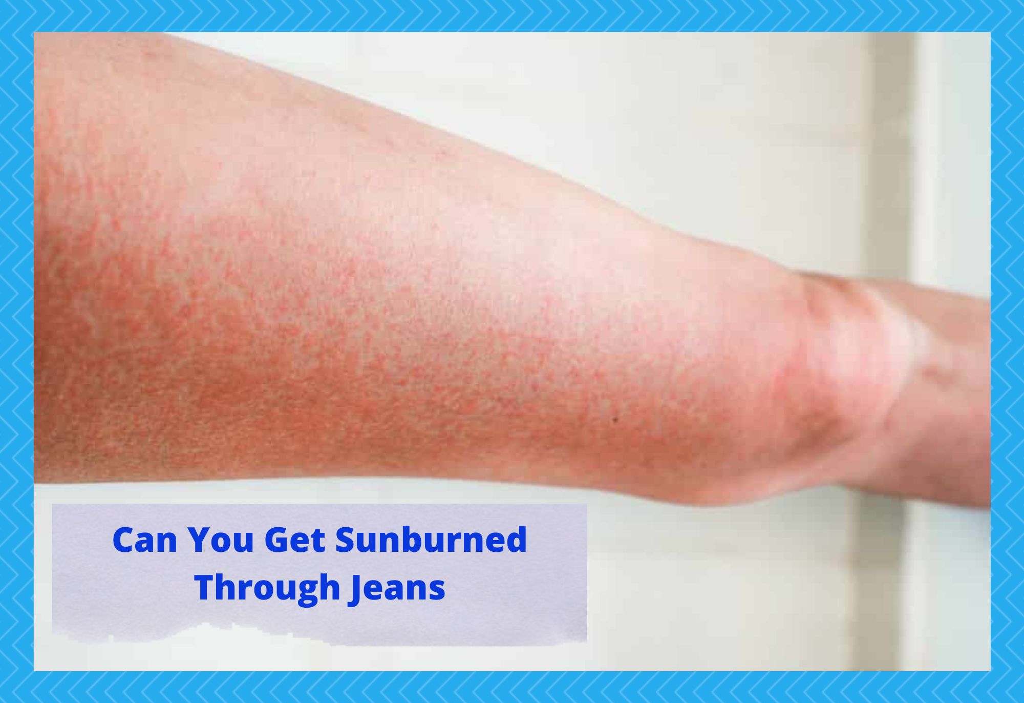 can you get sunburned through jeans